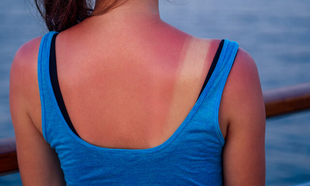 NORSK HUD: De fleste nordmenn har hudtype 1 og 2, som betyr at de blir aldri eller sjelden brun, og at huden er utsatt for solskader. Bildet viser solbrent hud hos en kvinne. Foto: NTB Scanpix / Shutterstock NORSK HUD: De fleste nordmenn har hudtype 1 og 2, som betyr at de blir aldri eller sjelden brun, og at huden er utsatt for solskader. Bildet viser solbrent hud hos en kvinne. Foto: NTB Scanpix / Shutterstock